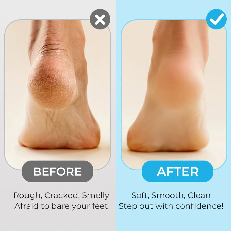 🔥2025 New Arrival💝New Digital Electric Foot Polisher - Image 4